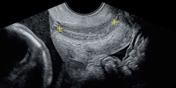 Cervical Scan: 16-40 Weeks