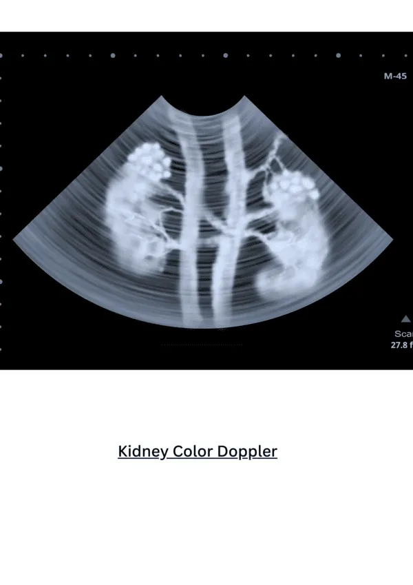 Kidneys, Ureters and Bladder Ultrasound
