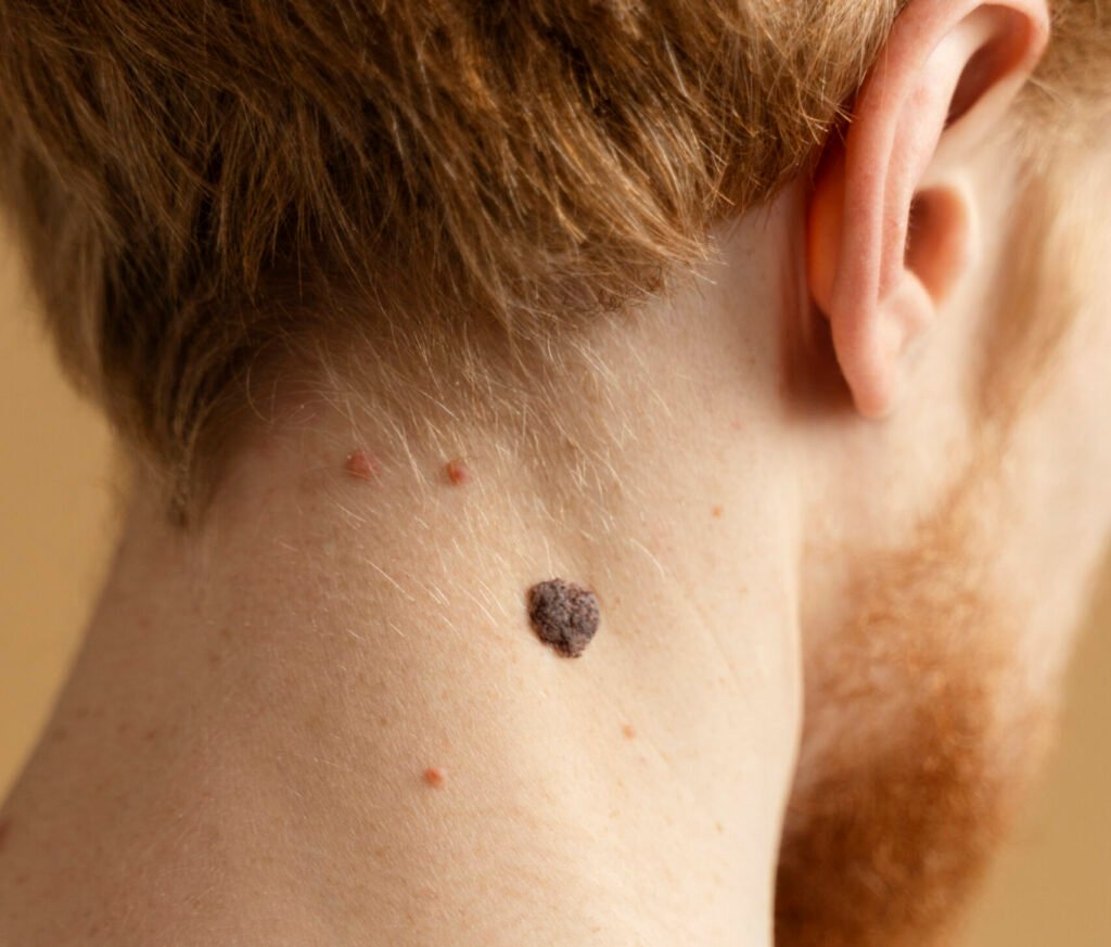 Skin Tag – Removal
