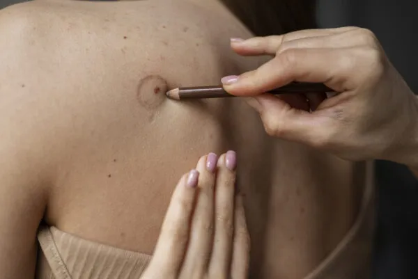 Mole Biopsy with Pathology Report