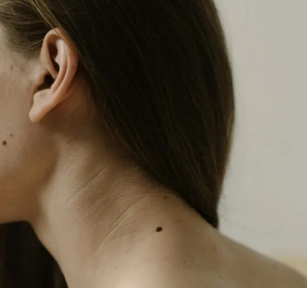 Mole Removal – Shave Method
